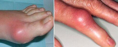 Auftreten von Gelenken mit Arthritis