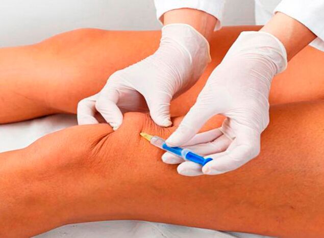 Intraartikuläre Injektionen von Medikamenten gegen Arthrose des Kniegelenks.