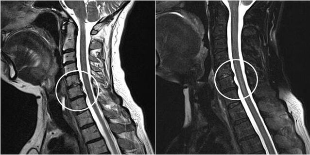 MRT der Halswirbelsäule mit Anzeichen einer Osteochondrose