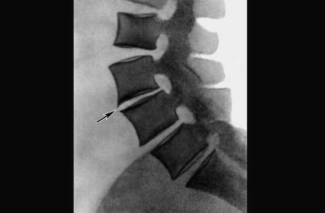 Manifestationen der Osteochondrose der Brustwirbelsäule im Röntgenbild. 