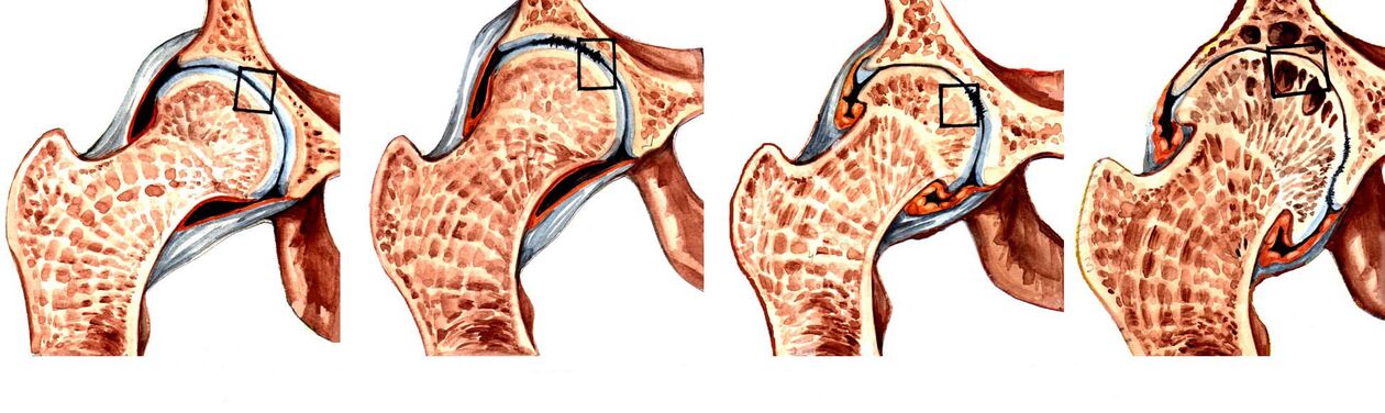 Grade der deformierenden Coxarthrose